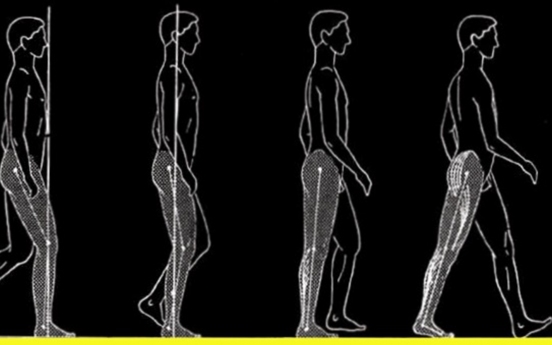 Neuroma di Morton