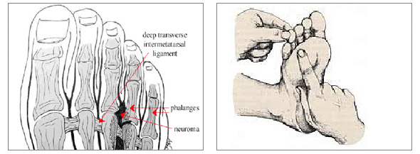 Neuroma di Morton con tecnica endoscopica